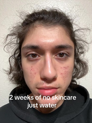 2 Weeks of No Skincare: Just Water