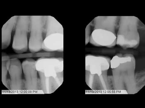 Tips and Tricks for Bitewing X-Rays