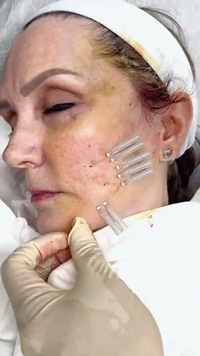 PDO Thread Mid-face lift with Smooth Thread Treatment by Dr. Tsay - Ageless MD