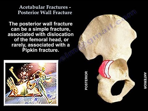 Acetabulum Fracture Posterior Wall Fracture - Everything You Need To Know - Dr. Nabil Ebraheim