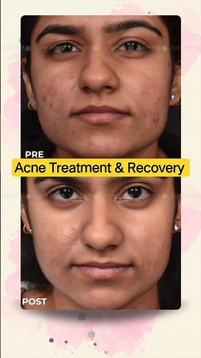 Acne Treatment & Recovery | How to Treat Severe Nodular Acne Effectively! | Clear Skin Clinic, Pune