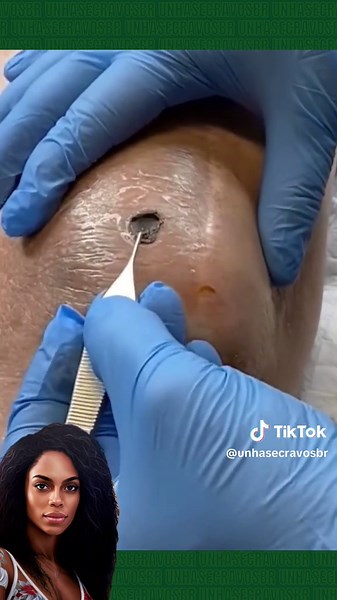 Giant Pimple Removal | Satisfying Blackhead Extraction