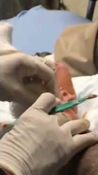 Abscess Removal *GRAPHIC*