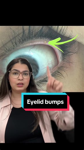 Understanding Meibomian Gland Dysfunction and Eye Discomfort