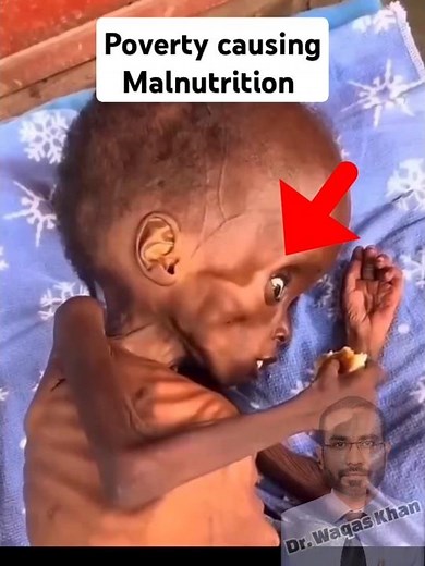 Protein energy malnutrition (PEM)