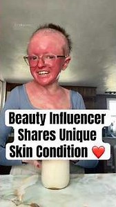 Beauty Influencer Shares Unique Skin Condition #shorts #tiktokinfluencer #skincondition