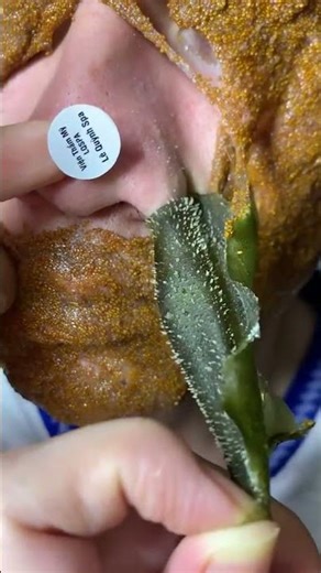 “Blackhead Removal Treatment 😍 | Whiteheads Clean | Satisfying Facial”