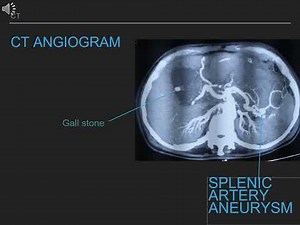 Splenic artery pseudoaneurysm embolization with nBCA glue
