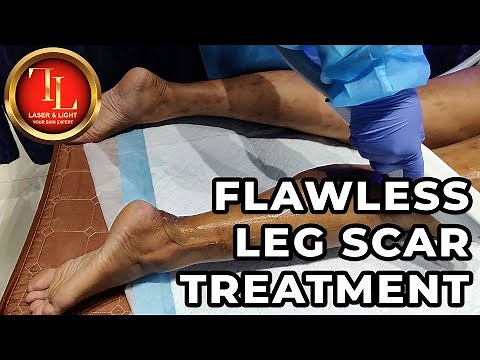 Leg Scar Removal Treatment
