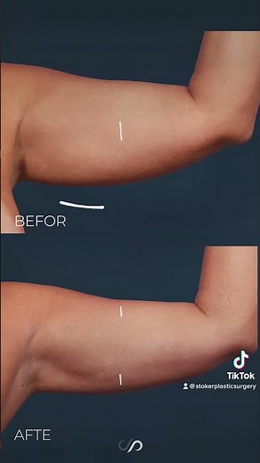 Before and After Video: Arm Liposuction Transformation
