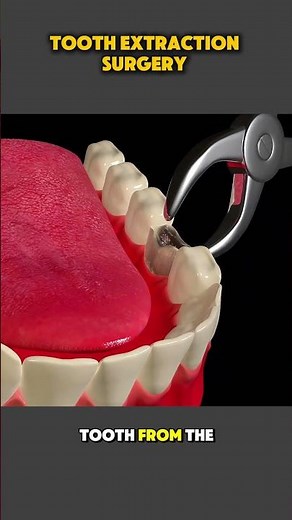 Tooth Extraction Procedure | What to Expect at the Dentist #toothextraction