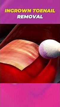 Ingrown Toenail Removal Procedure | 3D Animation in 60 Seconds #medicalshorts #medicalanimation