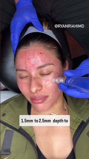 What are the benefits of Microneedling collagen induction therapy?