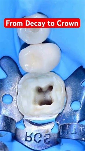 24s Transformation: Full Journey from Decay → Endo → Crown 🦷✨