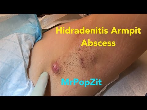 Hidradenitis Suppurativa armpit abscess drained. Instant pain relief with drainage of pocket.