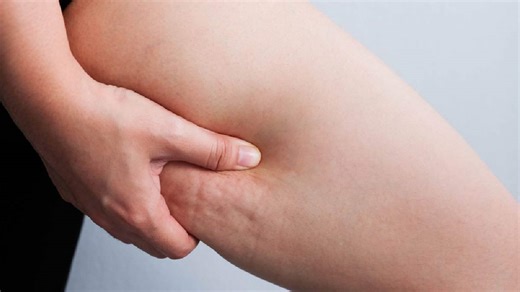 Cellulitis: Causes Of The Skin Condition That Mostly Affects Your Legs