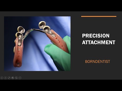 PRECISION ATTACHMENT IN RPD
