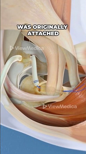 Tommy John Surgery (UCL Reconstruction) (3D Animation)
