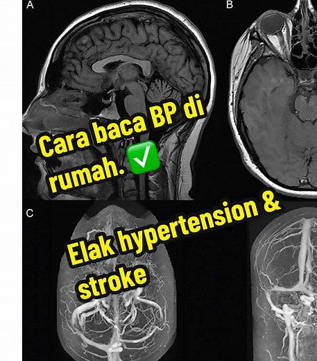 Cara Periksa Tekanan Darah di Rumah dengan Benar
