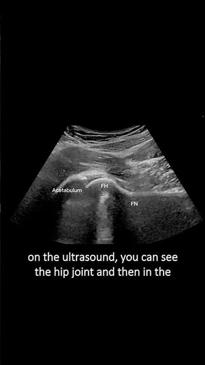 #ultrasound Guided Interventions: Cases (Hip Joint Injection)