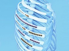 Matrix Rib Fixation System