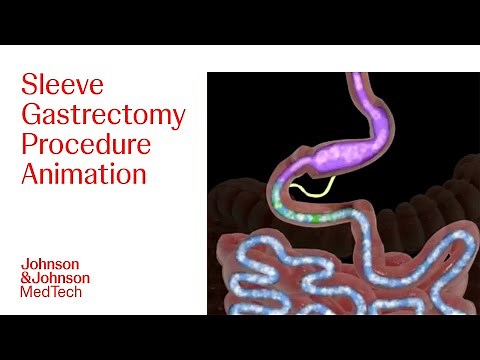 Sleeve Gastrectomy Procedure Animation | J&J MedTech