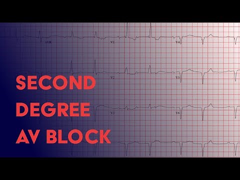 Second Degree Heart Block - Electrocardiogram (ECG/EKG) Interpretation