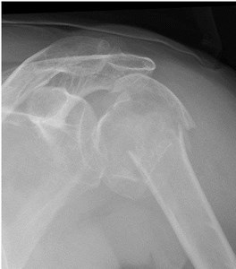 Proximal Humerus Fractures