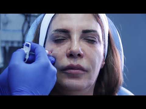 A FULL LIQUID FACE LIFT