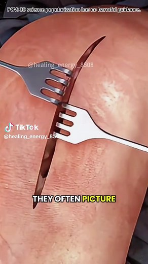 Total Knee Replacement Surgery Explained in 3D Animation