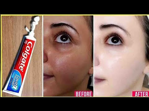 Apply Toothpaste on Your Skin and See Magical Result within 1 Hour | Amazing Toothpaste Beauty Hacks