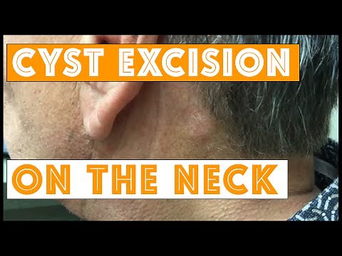 Cyst excision on the neck