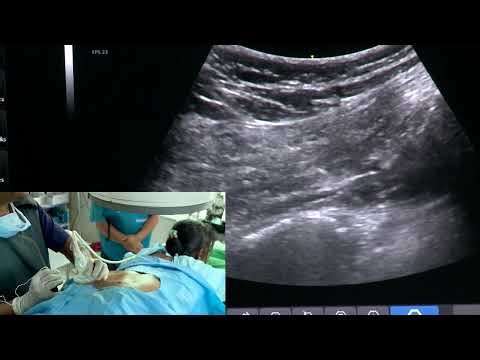Ultrasound and C-arm guided intervention for Piriformis Syndrome