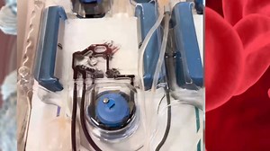 2.2K views · 43 reactions | What is apheresis? The staff at NIH’s Department of Transfusion Medicine explain all the different ways they use apheresis to support the NIH Clinical Center’s mission of providing hope through pioneering clinical research to improve human health. Learn more: https://www.cc.nih.gov/bloodbank/donation-types/drca | The NIH Clinical Center | Facebook