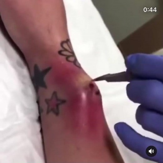 Cyst leak, Boil Popper, Cyst of the week