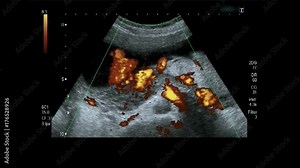 Obstetric Ultrasonography Ultrasound Echography of a fourth month fetus with histogram colors.