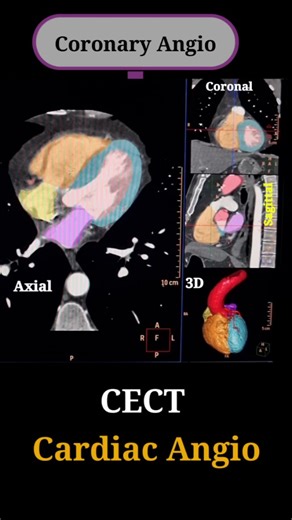 Anis Qureshi 🍁 on Instagram: "🫀 CT Cardiac Angiography – Coronary Artery Anatomy Explained Know the origin, course, and branches of coronary arteries on CT Cardiac Angio. A must-know topic for radiology students, technologists, and exam preparation. This reel explains the CT Cardiac Angiography anatomy, including coronary arteries and heart chambers as visualized on cardiac CT. 🔹 Coronary Arteries • Left Main Coronary Artery (LMCA) • Left Anterior Descending (LAD) • Left Circumflex (LCX) • Ri