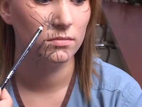 BOTOX PLANO DALLAS TUTORIAL: LOWER FACE