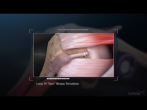 Loop ‘N’ Tack™ Biceps Tenodesis