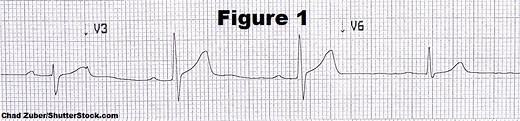 EKG Rhythm Practice Quiz for AV Heart Blocks | 1st Degree, 2nd Degree Types, & 3rd Degree Blocks
