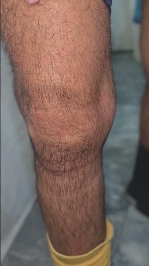Baker’s Cyst Explained 🦵 | Knee Swelling on Imaging #BakersCyst #KneePain #OrthoShorts