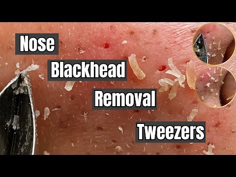 Nose Blackhead Removal Tweezers – Deep Pops That Tell a Silent Story | Pimple Spa