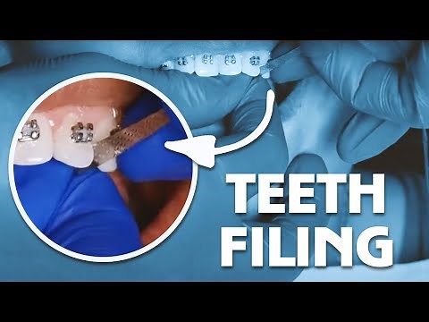 IPR Treatment During An Orthodontic Visit (Demo)