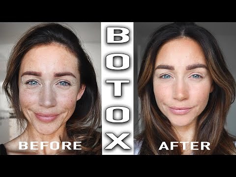 BOTOX TREATMENT BEFORE & AFTER