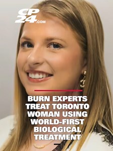 World-First Biological Treatment Saves Student’s Face After Burn
