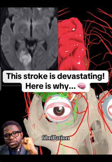 Replying to @crokat1919 Anatomy of a PCA Stroke: From Heart to Vision Loss Posterior circulation anatomy is vital for accurately localizing salient strokes. Common PCS etiologies (PCA/BA/VA): • Cardioembolic: AF/LAA clot • Artery→artery: VA/BA/PCA atherosclerosis • Dissection (VA) ± neck trauma/manip • Small-vessel: thalamic/perforators • Hypoperfusion: vertebrobasilar stenosis RF: smoking HLD HTN DM. Clues: HH, diplopia, vertigo/ataxia, dysarthria, AMS/thalamic pain. @Kevin Kern, DC #neurointer