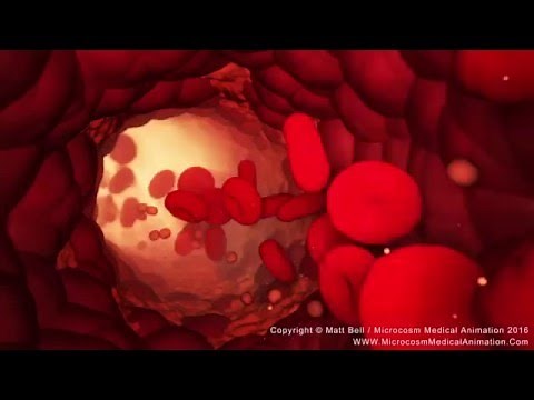 Bloodflow; Cholesterol Build-Up In An Artery / Microcosm Medical Animation