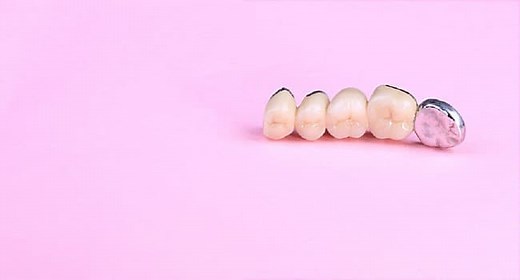 An Overview of Dental Bridges to Replace Missing Teeth