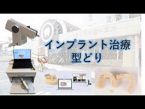 インプラント治療 シリコーン印象と光学印象 セットまで Implant treatment impression. optical impression trial fitting set