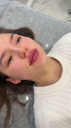 Контурная пластика губ Belotero Lips 0.66 ml